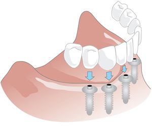 Implantatgetragene Prothese